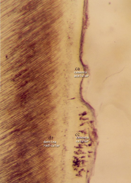 Cementos acelular e celular e zona granulosa de Tomes (dentina)