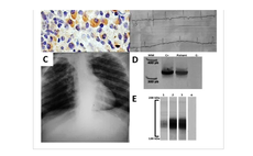 Pesquisadores alertam que droga causa alterações no coração de quem tem doença de Chagas crônica. Na imagem, dados clínicos e achados laboratoriais de um paciente com a coinfecção. Crédito: Tropical Medicine and Infectious Disease/Reprodução